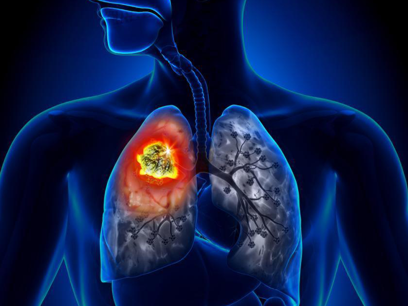 Lung Cancer