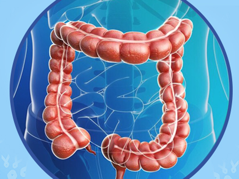 Colorectal Cance