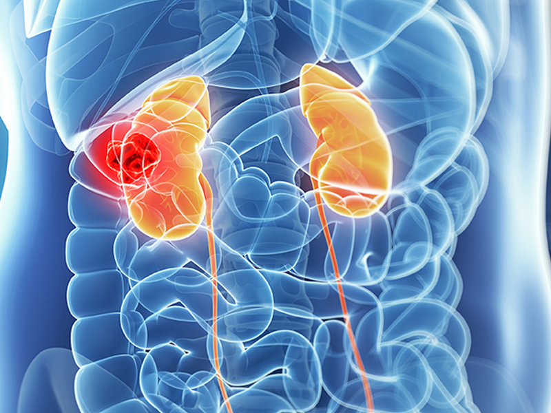 Kidney Cancer