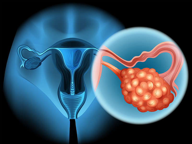 Ovarian Cancer