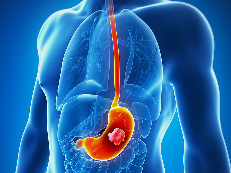 Gastric Cancer