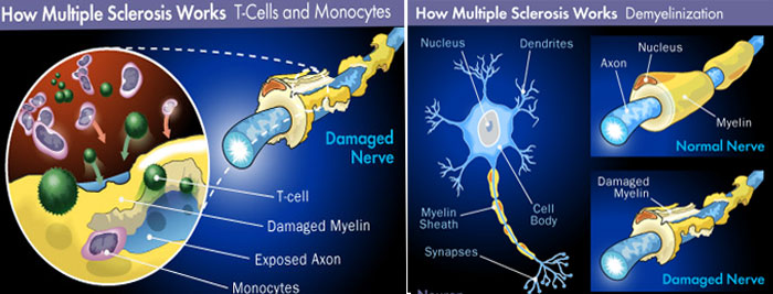 Multiple Sclerosis (T-Cell and Demyelinization)